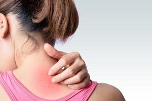 woman scraching rash at upper back and neck photo