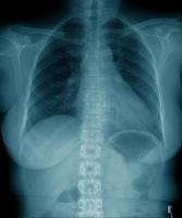 chest x-ray image in blue tone photo