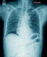 chest x-ray image in blue tone black background, lung infection with secretion photo