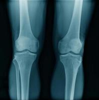 OA knee x-ray image Posteo-anterior view photo