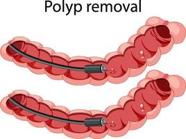 Diagram showing polyp removal vector