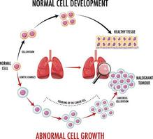 Diagram showing cancer development process vector