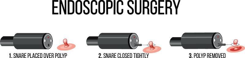 Diagram showing endoscopic surgery vector