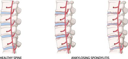 Infographic of healthy spine and ankylosing spondylitis vector