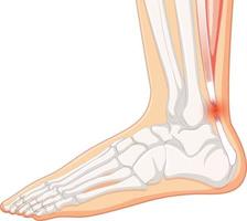 Achilles tendo rupture on white background vector