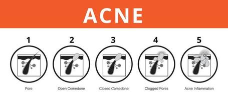 acné, etapas de desarrollo, piel sana, diseño vectorial vector