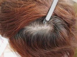 Closeup head with thinning hair, hair loss photo