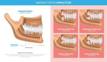 Wisdom Tooth Impaction Infographics vector