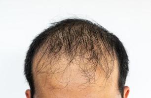 Close up of Asian male pattern baldness.