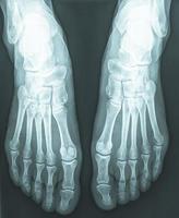 female feet xray radiograph photo