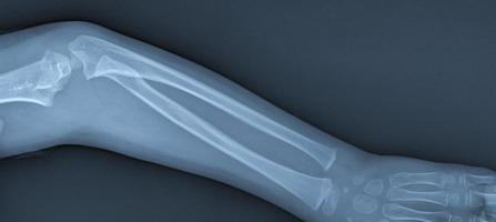 Broken arm xray photo