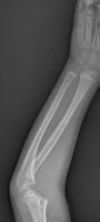 Broken arm xray photo