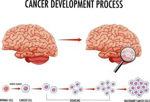 diagrama que muestra el cáncer en el cerebro humano vector