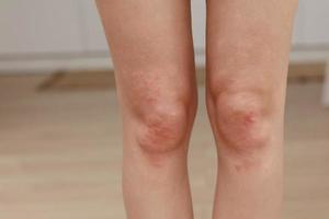 skin allergies, legs skin women. Closeup of red pustules on a knee, an allergic reaction caused by atopic dermatitis. Selected focus photo