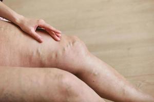 venas varicosas y arañas dolorosas en las piernas de las mujeres activas, ayudándose a sí misma a superar el dolor. enfermedad vascular, problemas de venas varicosas, concepto de vida activa. foto