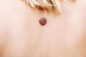 Wart. Mole. big wart on the skin. Skin diseases Malignant tumor. Dermatology. Oncology. selective focus. photo