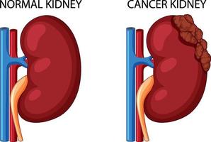 riñón normal y riñón con cáncer vector