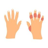 Hands with rheumatoid arthritis disease in cartoon flat style. Vector illustration of sick stiffness swollen joints. Human disorder.