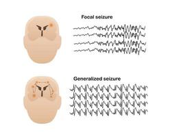 Illustration of seizure types demonstrating by onset and brain waves vector