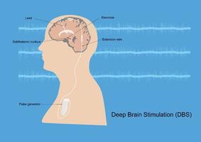 Deep brain stimulation for Parkinson's disease vector