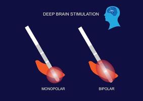 Brain stimulation mode of DBS for Parkinson's disease vector