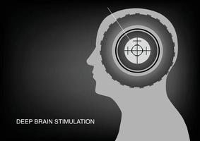 cirugía de estimulación cerebral profunda para la enfermedad de parkinson vector