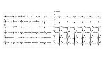 ilustración de electrocardiograma normal sobre fondo blanco. vector