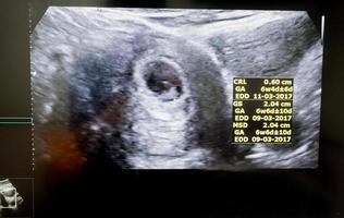 Obstetric Ultrasound of embryo at sixth week photo