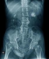 Renal calculus or kidney stone x-ray image in blue tone photo