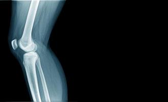imagen de rayos x de la articulación de la rodilla en tono azul