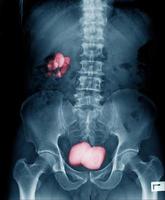 Renal calculus or kidney stone x-ray image in blue tone photo