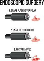 Diagram showing endoscopic surgery vector