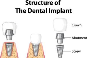 infografía de humanos en la estructura del implante dental. vector