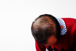 A Young Men Is Hair Loss. Bald Head. Hair Loss Men. photo