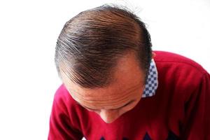 A Young Men Is Hair Loss. Bald Head. Hair Loss Men. photo