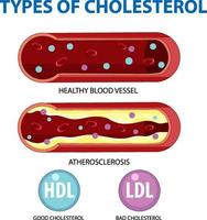 Types of Cholesterol HDL and LDL vector