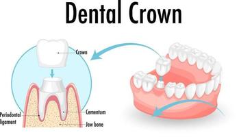 infografía de humano en corona dental vector