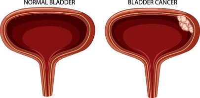 etapa del cáncer de vejiga vector