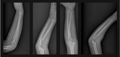 Broken arm xray photo