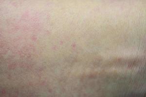 ill allergic rash dermatitis eczema skin of patient photo