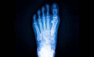 película de rayos x de pies humanos foto