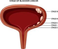 Stage of bladder cancer vector