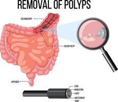 Diagram showing removal of polyps vector