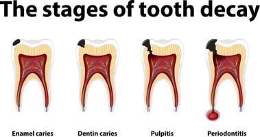 Infographic of human in the stages of tooth decay vector