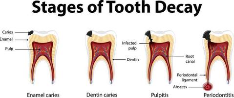 Infographic of human in the stages of tooth decay vector