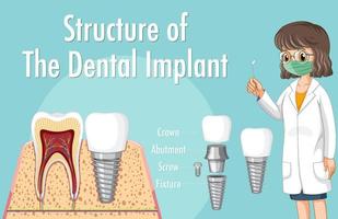 infografía de humanos en la estructura del implante dental. vector