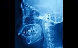 película de rayos X del cráneo y vista lateral de la columna cervical para el concepto médico. foto