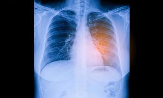 Insuficiencia cardíaca, radiografía de tórax en posición vertical muestra cardiomegalia e infiltrado intersticial ambos foto