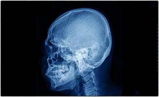 película de rayos X del cráneo y vista lateral de la columna cervical para el concepto médico. foto