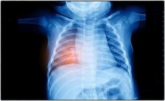 Insuficiencia cardíaca, radiografía de tórax en posición vertical muestra cardiomegalia e infiltrado intersticial ambos foto